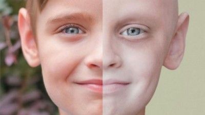 сравнение кожи на лице ребенка